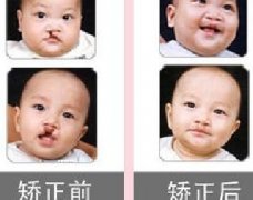 吃兔肉真的會(huì)長(zhǎng)兔唇？為什么會(huì)長(zhǎng)兔唇？